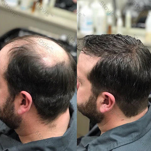 STOVIS™ ⭐⭐⭐⭐PRO SPRAY CRECIMIENTO DE CABELLO